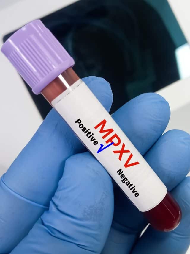 WHO Reveals Mpox Details: Symptoms & Treatment
