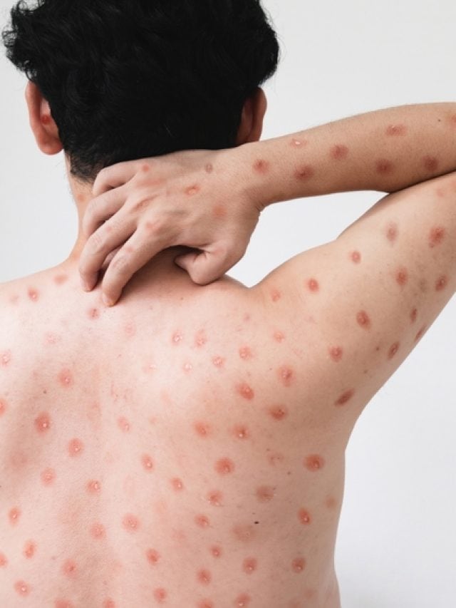 MPOX: A Real Threat Or Just A Hoax?