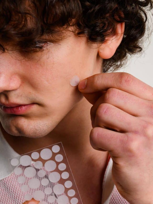Benefits of acne patches & how to use them effectively
