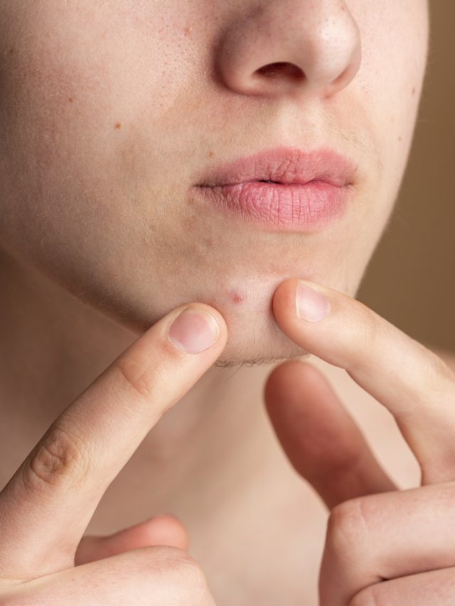 5 foods that can help you control hormonal acne 5 foods that can help you control hormonal acne