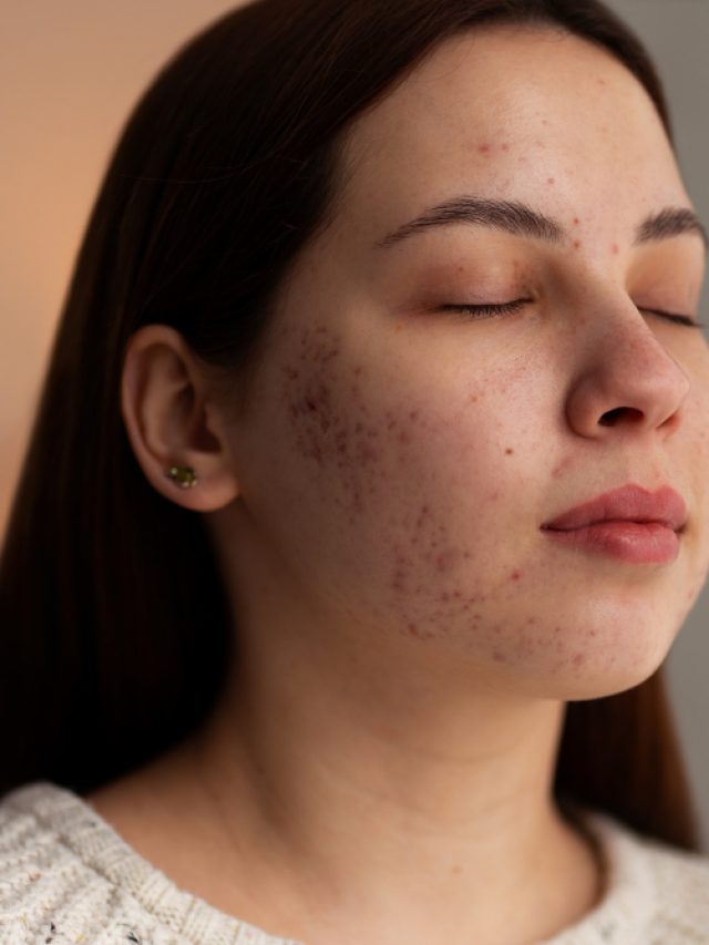 5 Simple ways to use moringa for acne-free skin 5 Simple ways to use moringa for acne-free skin