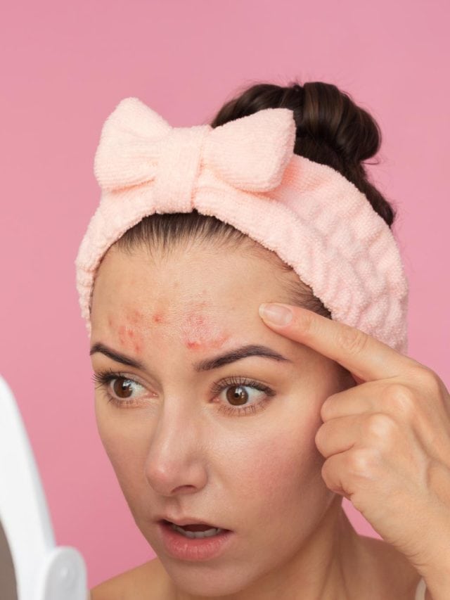 How to control hormonal acne?