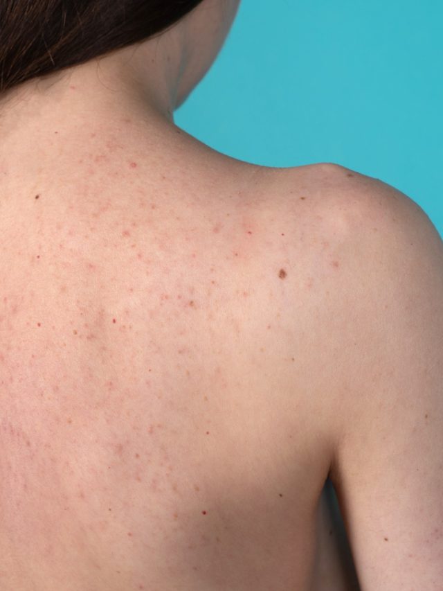 How to get rid of back acne?
