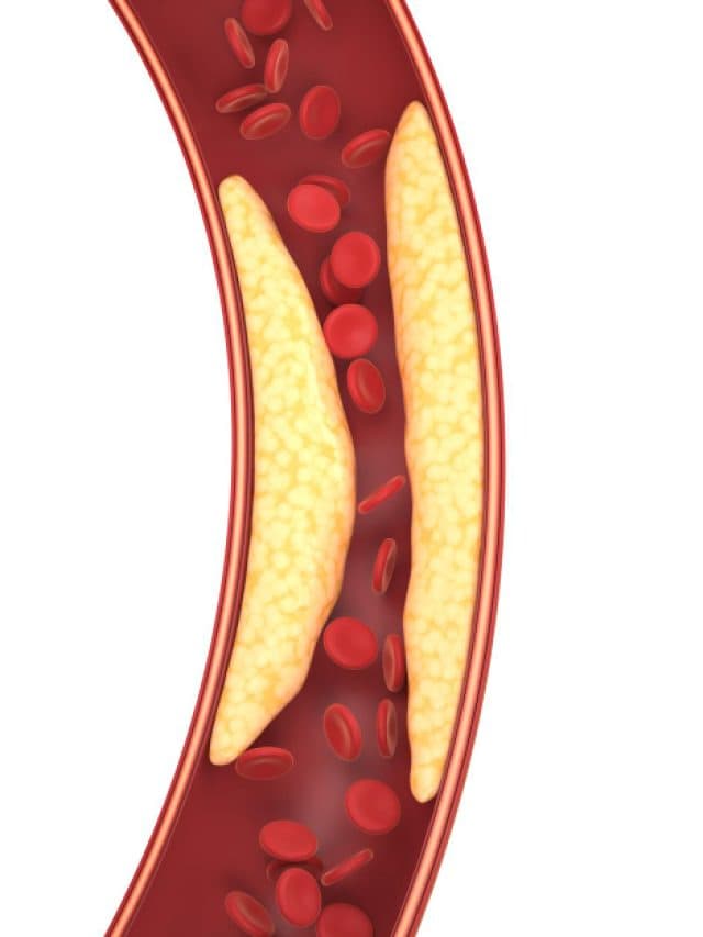 5 key signs of high LDL in legs & hands