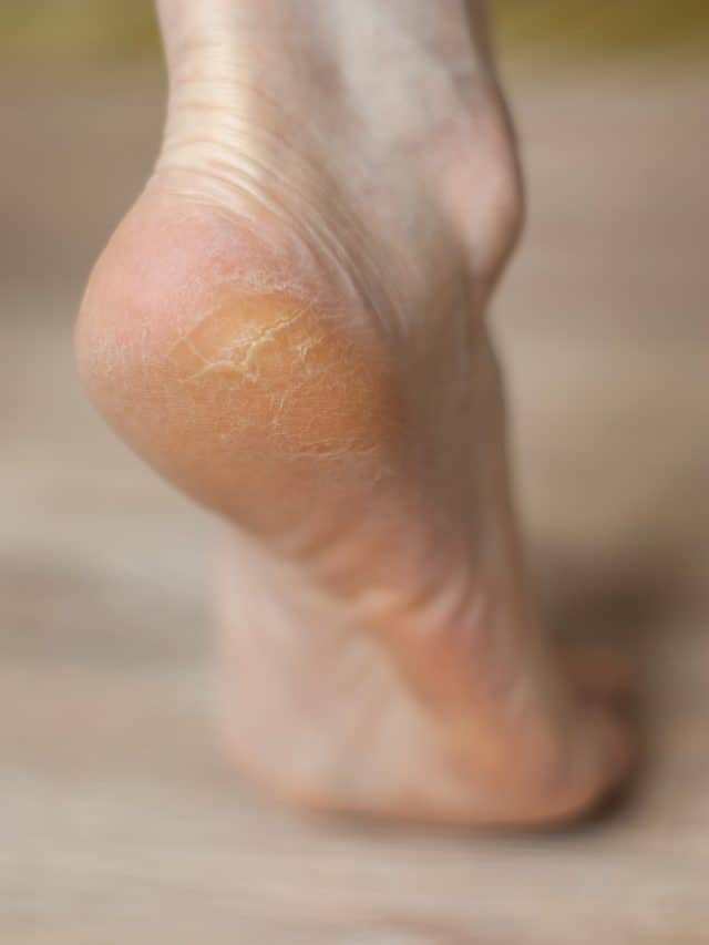 6 tips to treat cracked heels during winter