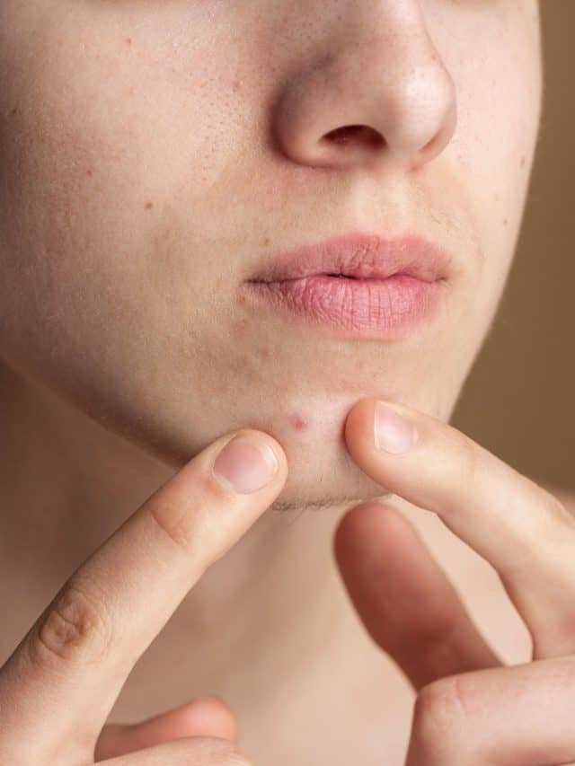 Acne breakouts? 5 simple masks you can make at home