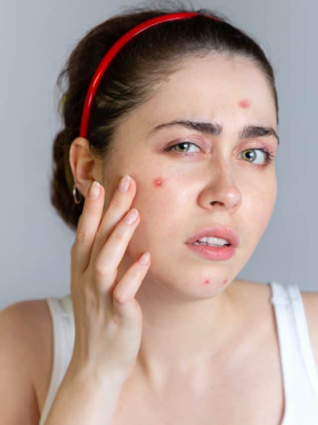 6 tips for banishing pimples fast