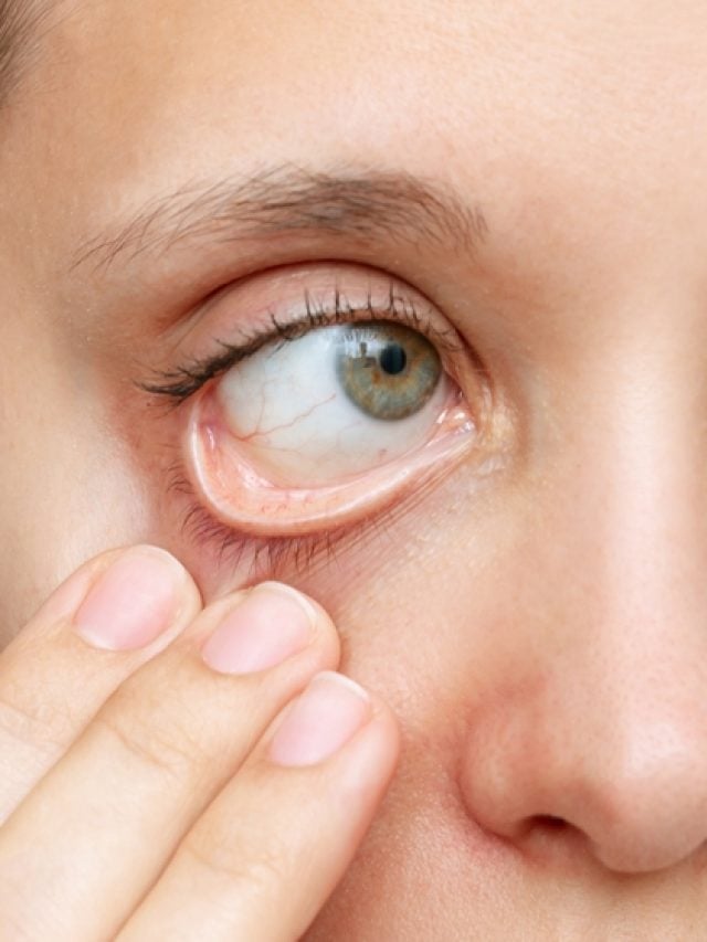 Anemia symptoms you shouldn’t ignore – Know the signs!