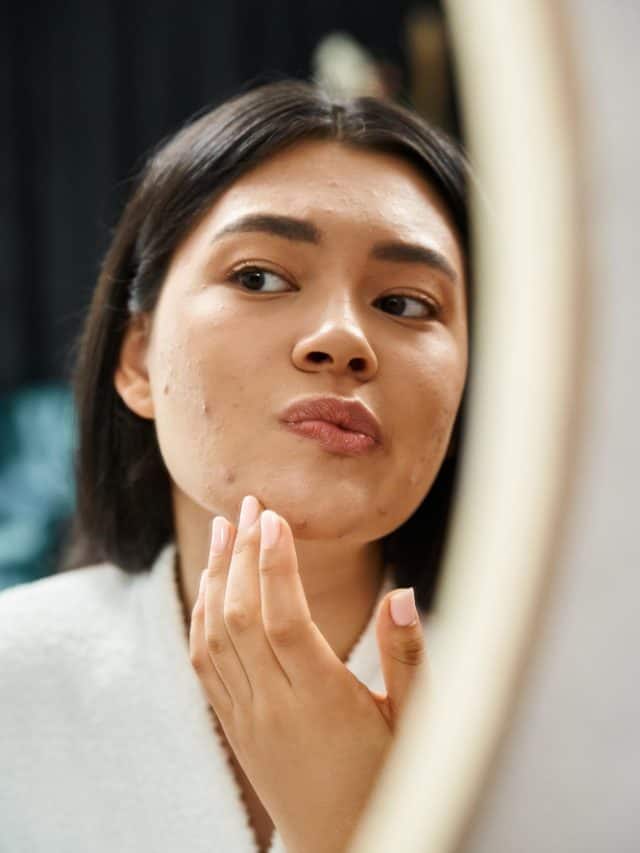 6 tips for acne-free clear skin