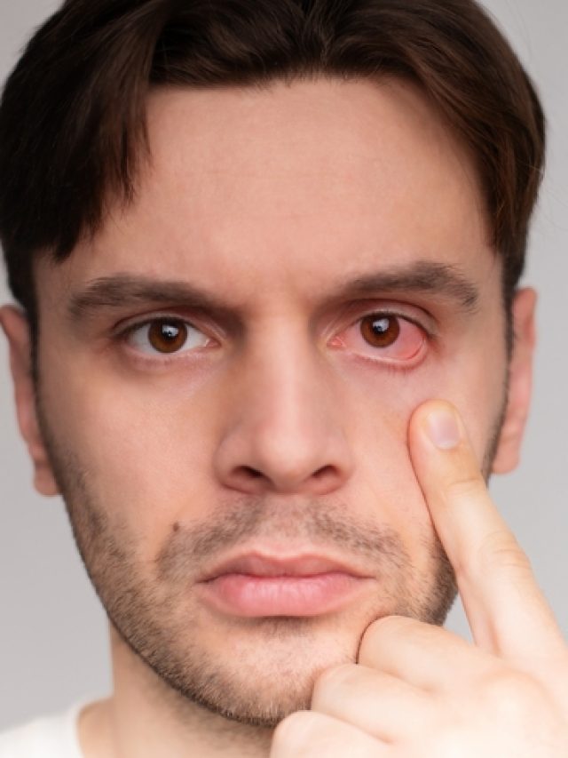 6 effective home remedies for pink eye 6 effective home remedies for pink eye