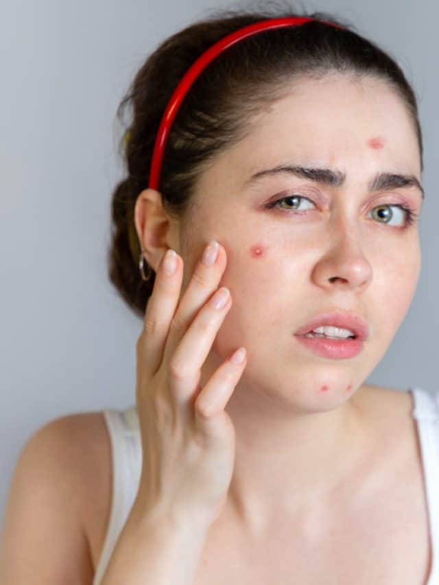 Skin suddenly breaking out? Here’s what to do Skin suddenly breaking out? Here’s what to do