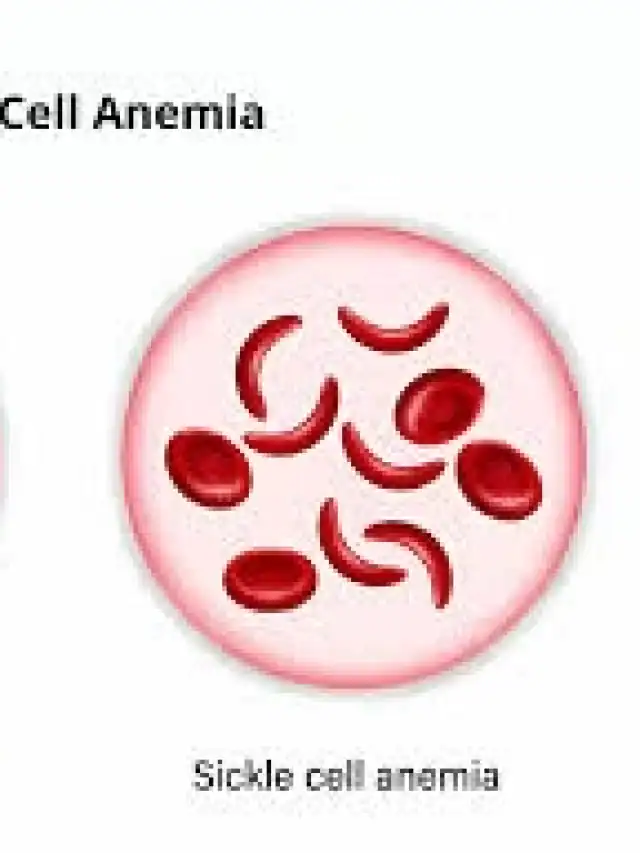 Early warning signs of sickle cell you need to know Early warning signs of sickle cell you need to know