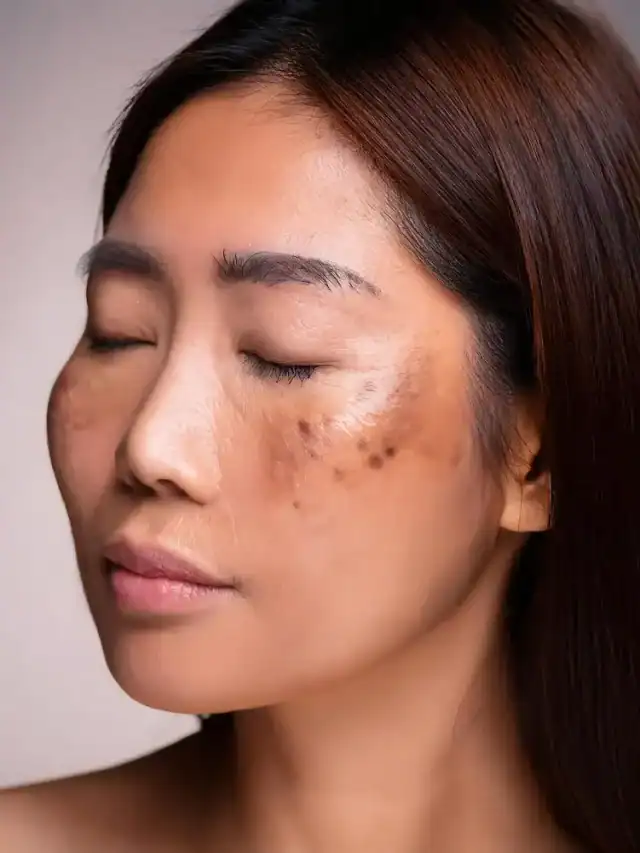 Pigmentation getting worse? Here’s what you can do Pigmentation getting worse? Here’s what you can do