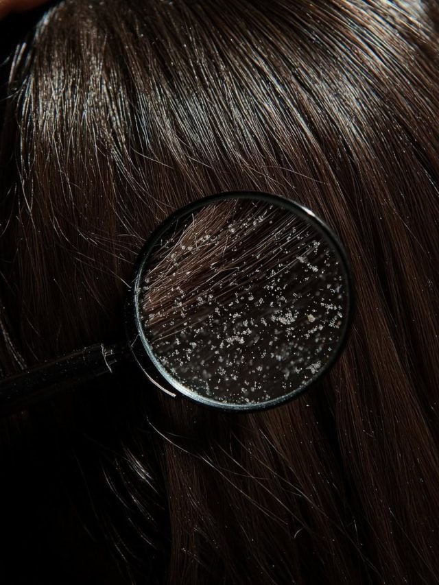 सर्दियों में डैंड्रफ? आजमाएं ये आसान होम रेमेडीज