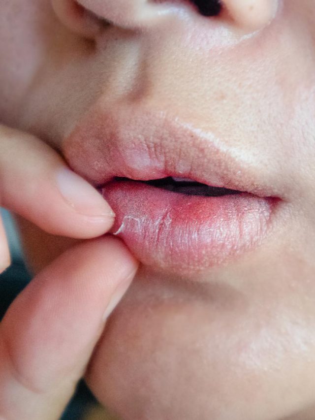 How to treat chapped lips naturally during this season How to treat chapped lips naturally during this season