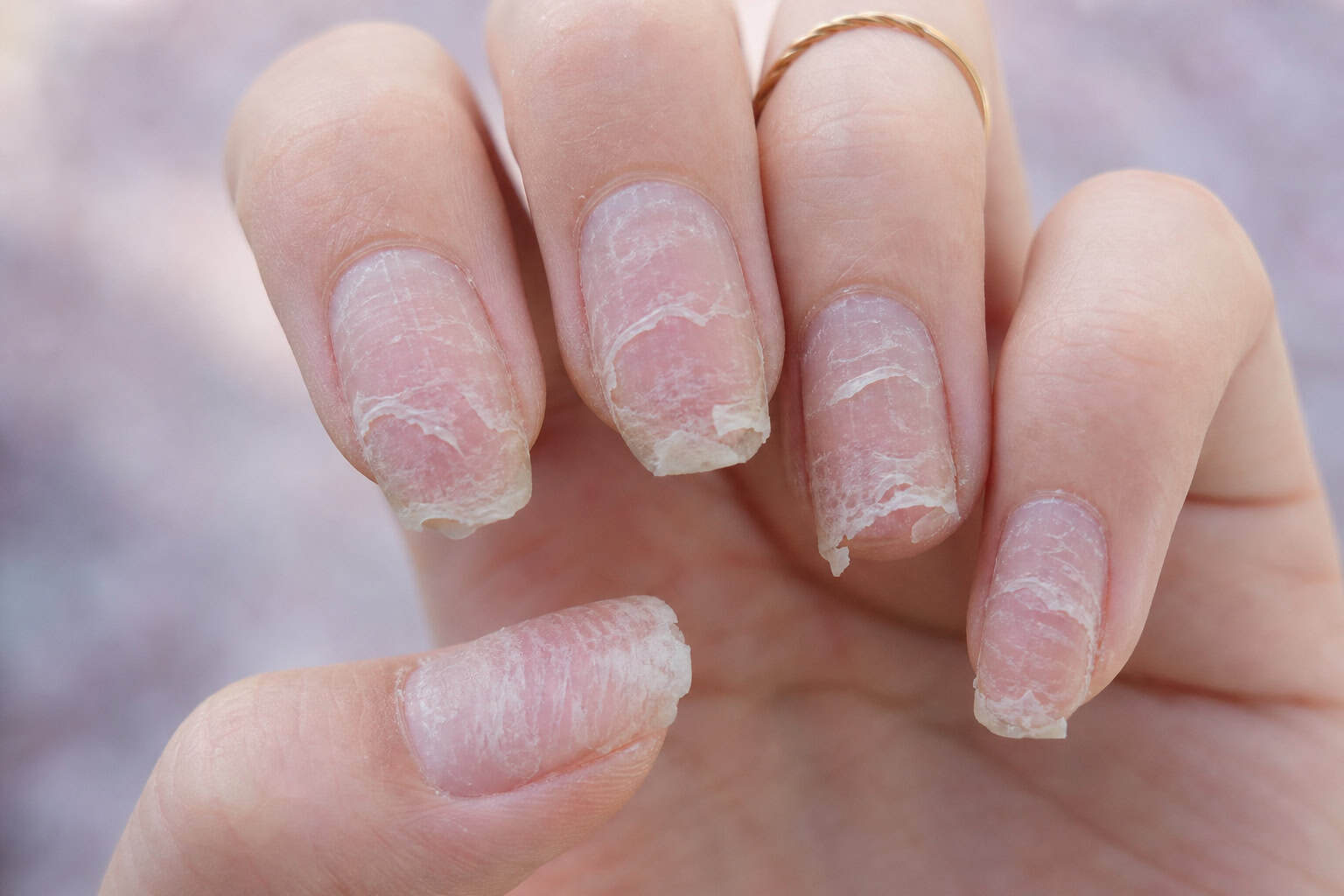 What Causes Brittle Nails? 7 Reasons & How to Fix Them What Causes Brittle Nails? 7 Reasons & How to Fix Them