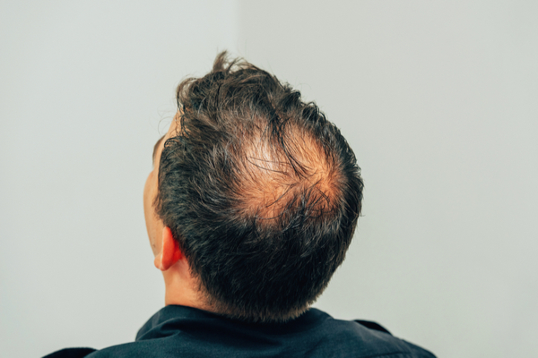 Causes of Baldness