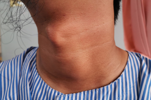 Goiter causes of hypothyrodisim