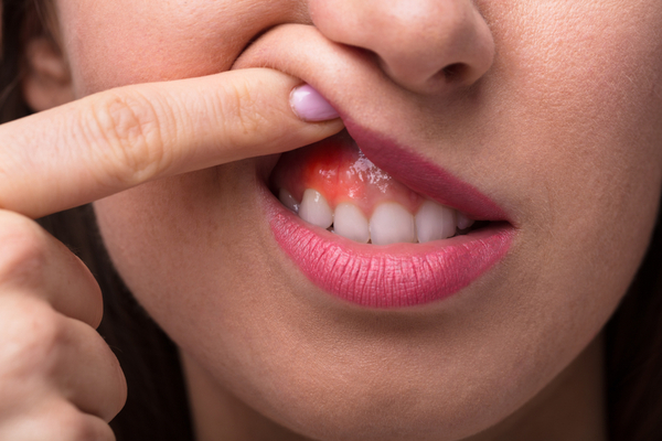 Gum swelling - symptoms