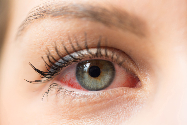 Nagarmotha benefits in eye disease