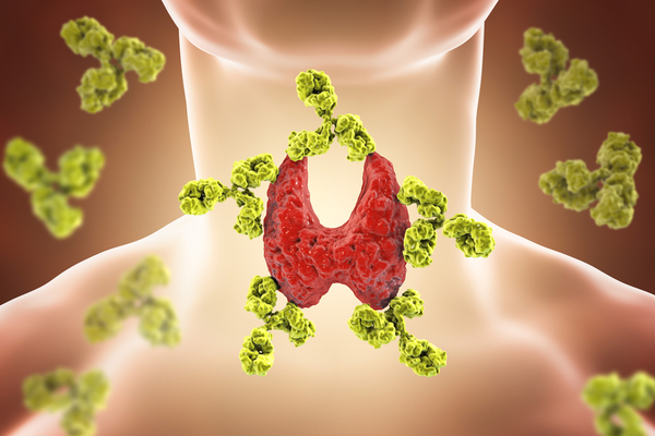 hashimoto causes of hypothyrodisim