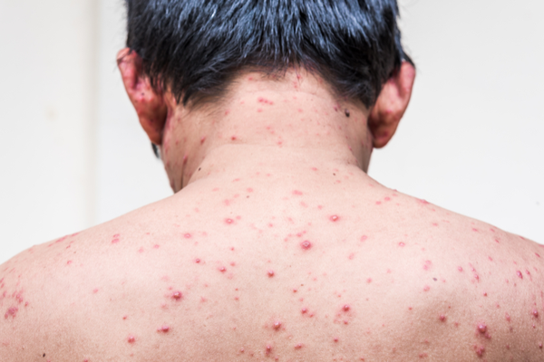 Gular benefits in Chickenpox