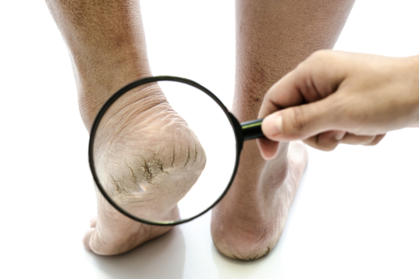 Benefits of amaltas in Cracked Heel