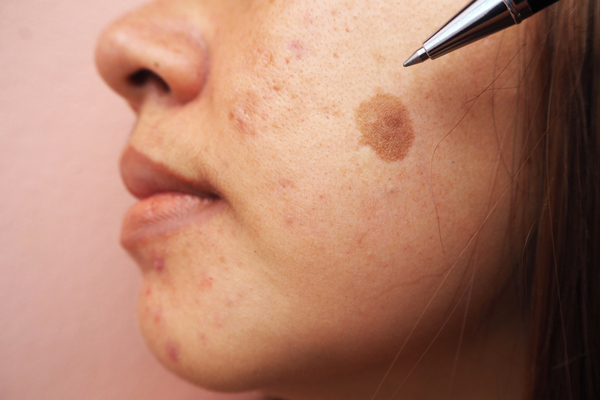 Melasma on face