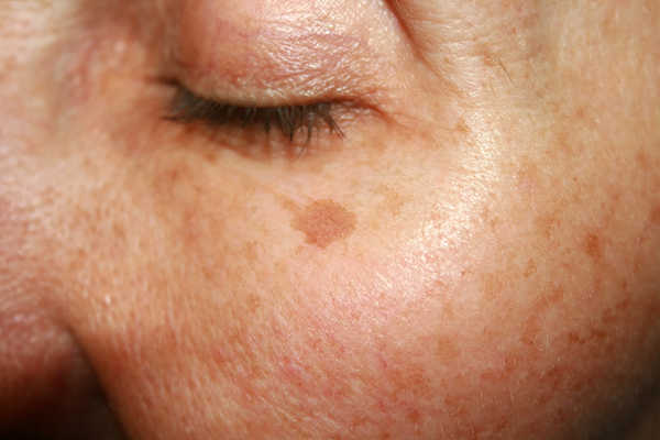 Masoor benefits in Pigmentation of face