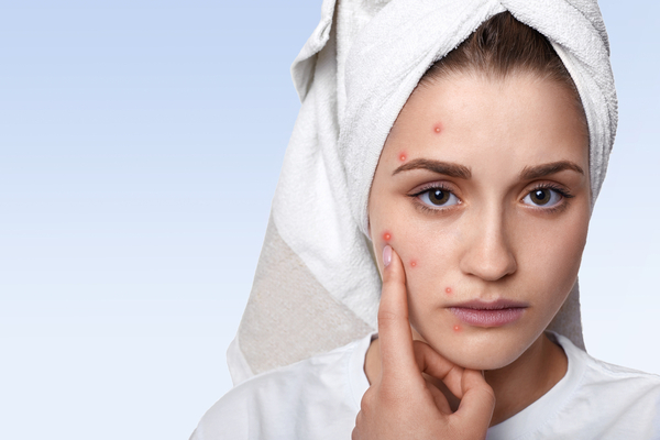 Vacha benefits in acne treatment