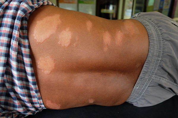 Vacha benefits in Leprosy