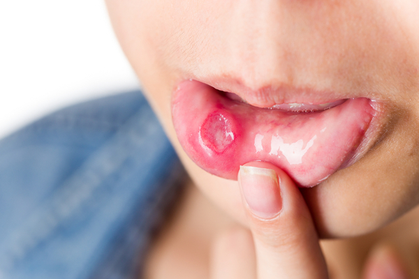 Ustukhuddus benefits in mouth ulcer