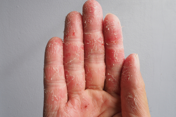 Eczema home remedies