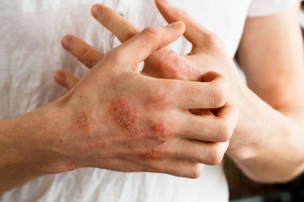 Eczema