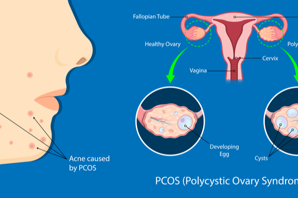 Polycystic ovarian syndrome image