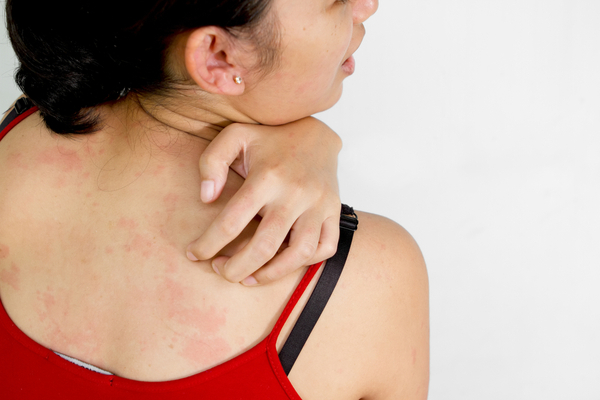moongfali benefits in Skin disease 