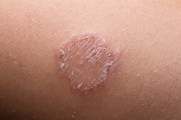 Ringworm symptoms