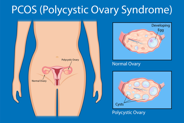 Polycystic ovarian syndrome