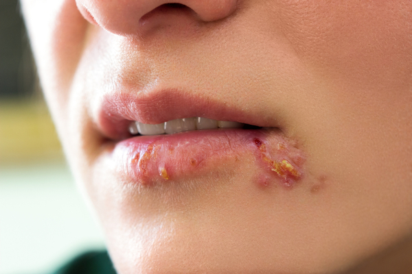 Herpes disease