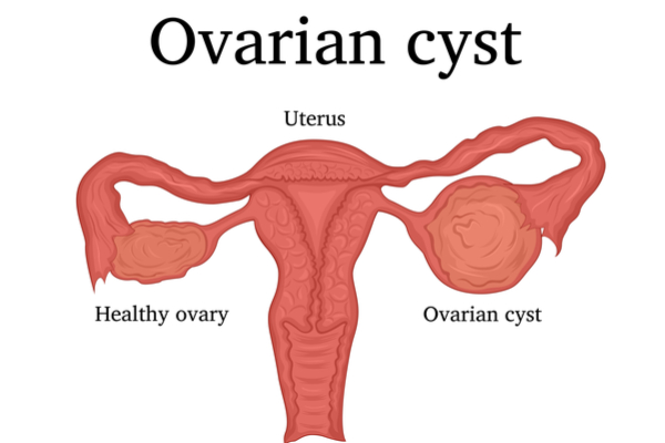 Ovarian Cyst