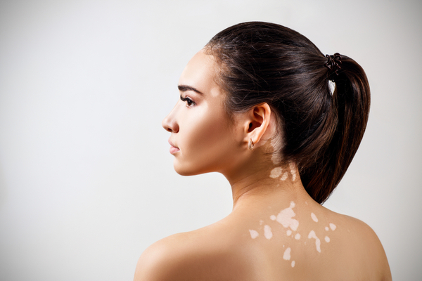 Vitiligo- prevention tips