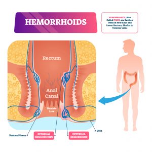 Piles (Hemorrhoids) home remedies