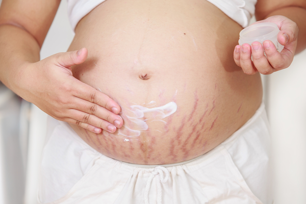 Pregnancy stretch marks home remedies