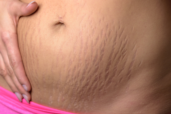 Stretch marks home remedies