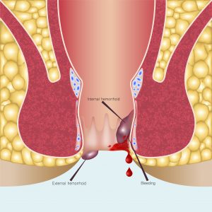 Red Kanchnar Guggulu Benefits for Piles (Hemorrhoids) Treatment