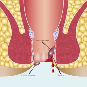 Benefits of Darbh for Piles Treatment